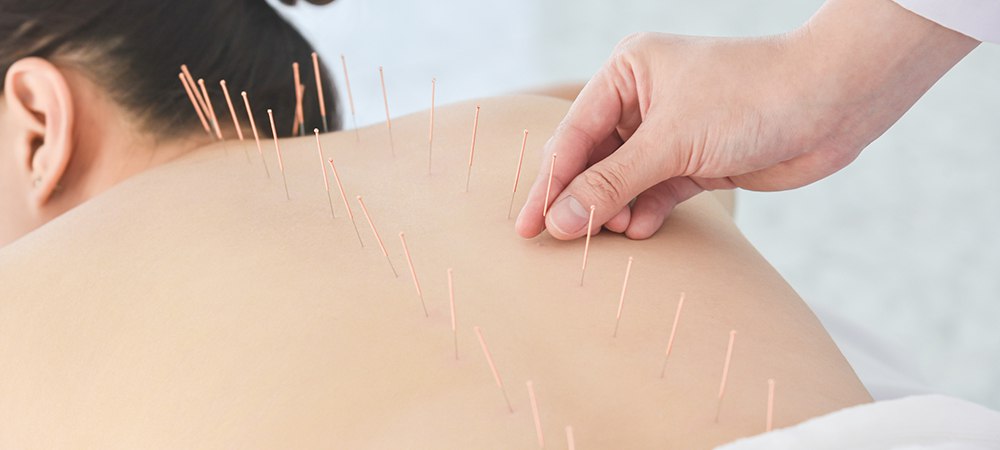 acupuncture